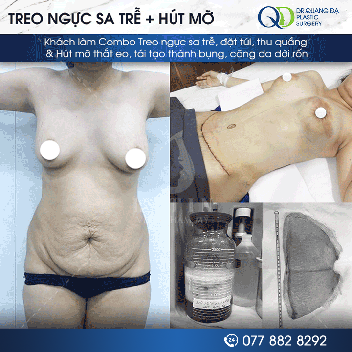 Kết quả treo sa trễ ngực phì đại hướng đến bầu ngực gọn hơn, nhẹ hơn và cân đối tự nhiên với vóc dáng