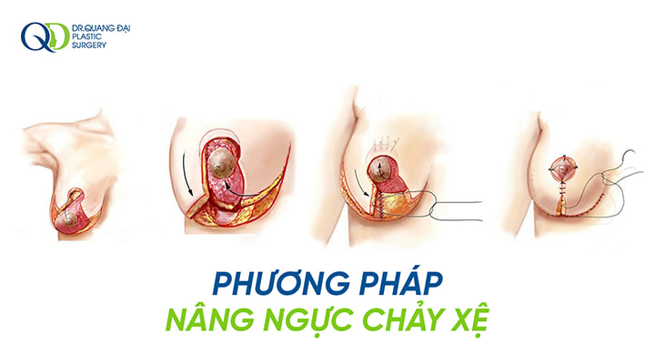 Phương pháp nâng ngực chảy xệ tại viện thẩm mỹ Trịnh Quang Đại