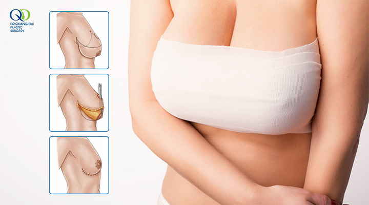 Quy trình phẫu thuật thu gọn ngực phì đại sau sinh