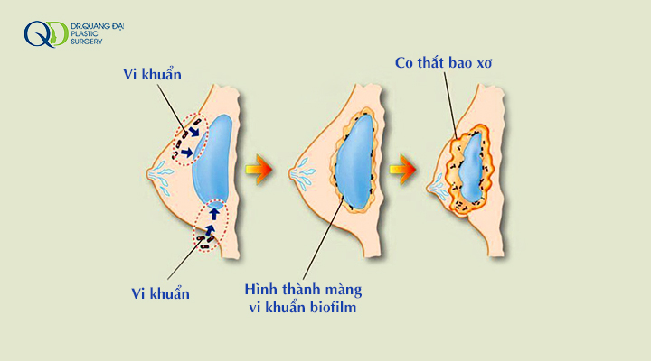 Co Thắt Bao Xơ Sau Nâng Ngực Và Cách Khắc Phục