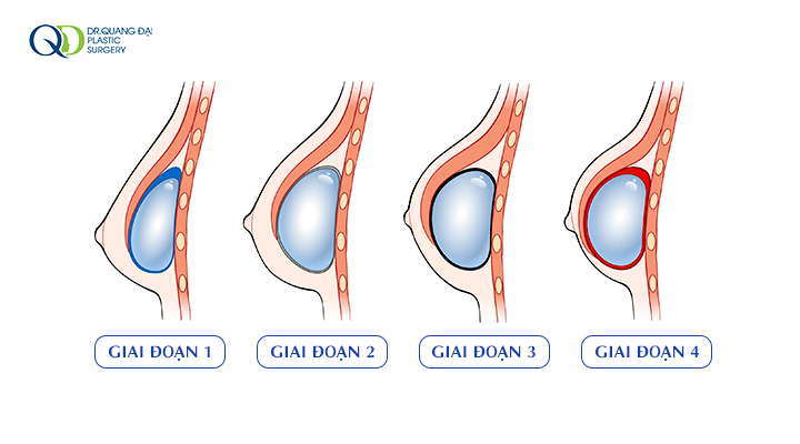 Co Thắt Bao Xơ Sau Nâng Ngực Và Cách Khắc Phục