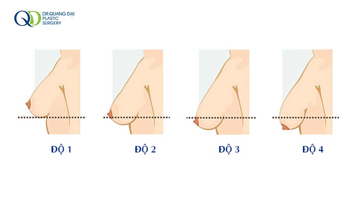 Cấp độ Sa Trễ Ngực