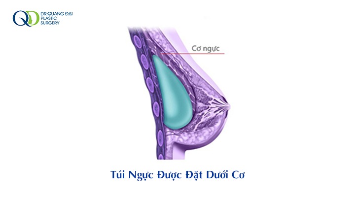 Đặt túi ngực dưới cơ