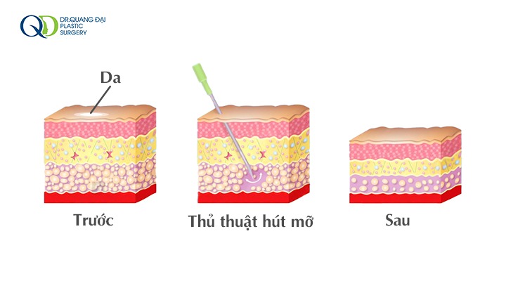 Hút mỡ bụng uy tín