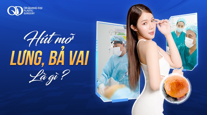 hút mỡ lưng vai