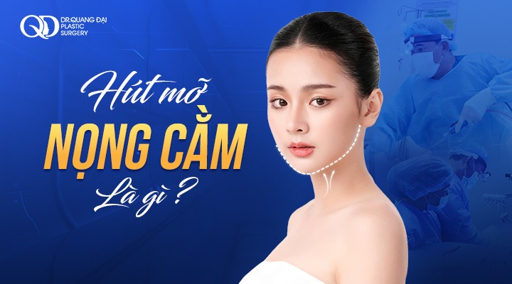 Quy trình Hút mỡ nọng cằm