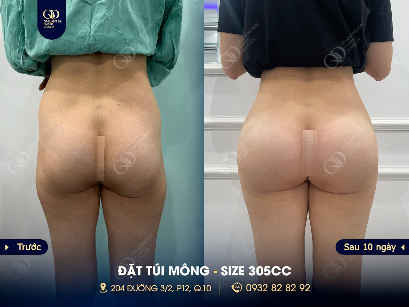 Chi phí nâng mông thấp có phải lúc nào cũng tốt