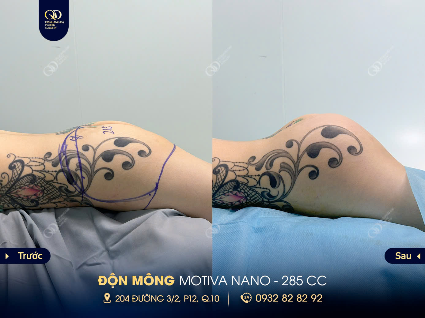 Dấu hiệu nhận biết bác sĩ nâng mông giỏi trước khi đặt lịch