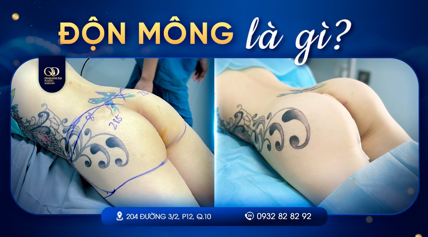 độn mông là gì