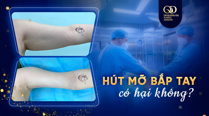 hút mỡ bắp tay bao lâu lành