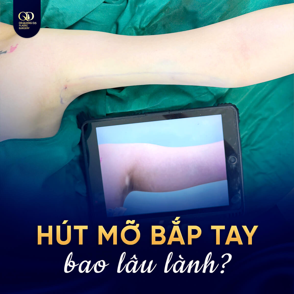 hút mỡ bắp tay bao lâu lành