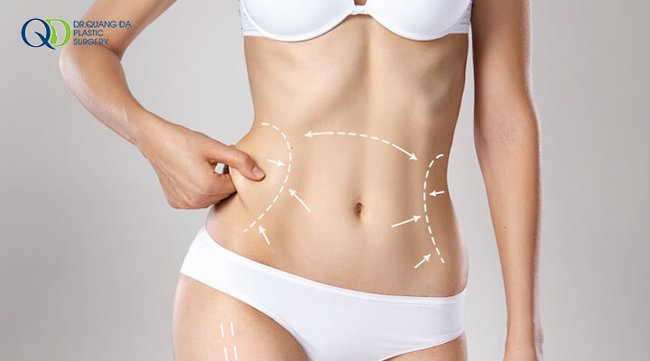 Hút mỡ bụng không cần căng da