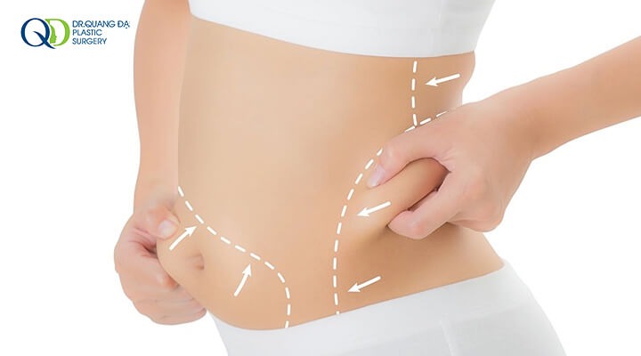 hút mỡ bụng là gì