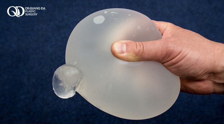 nâng ngực dùng được bao lâu