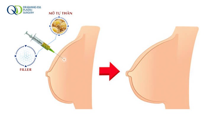 Nâng ngực không phẫu thuật có an toàn không
