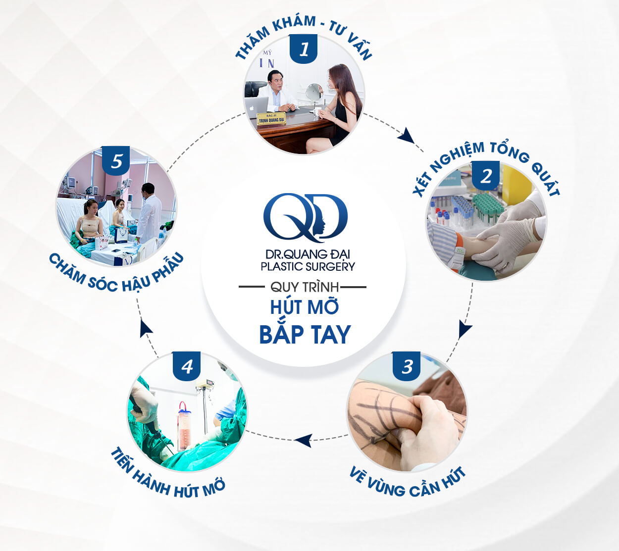 hút mỡ bắp tay bao lâu lành