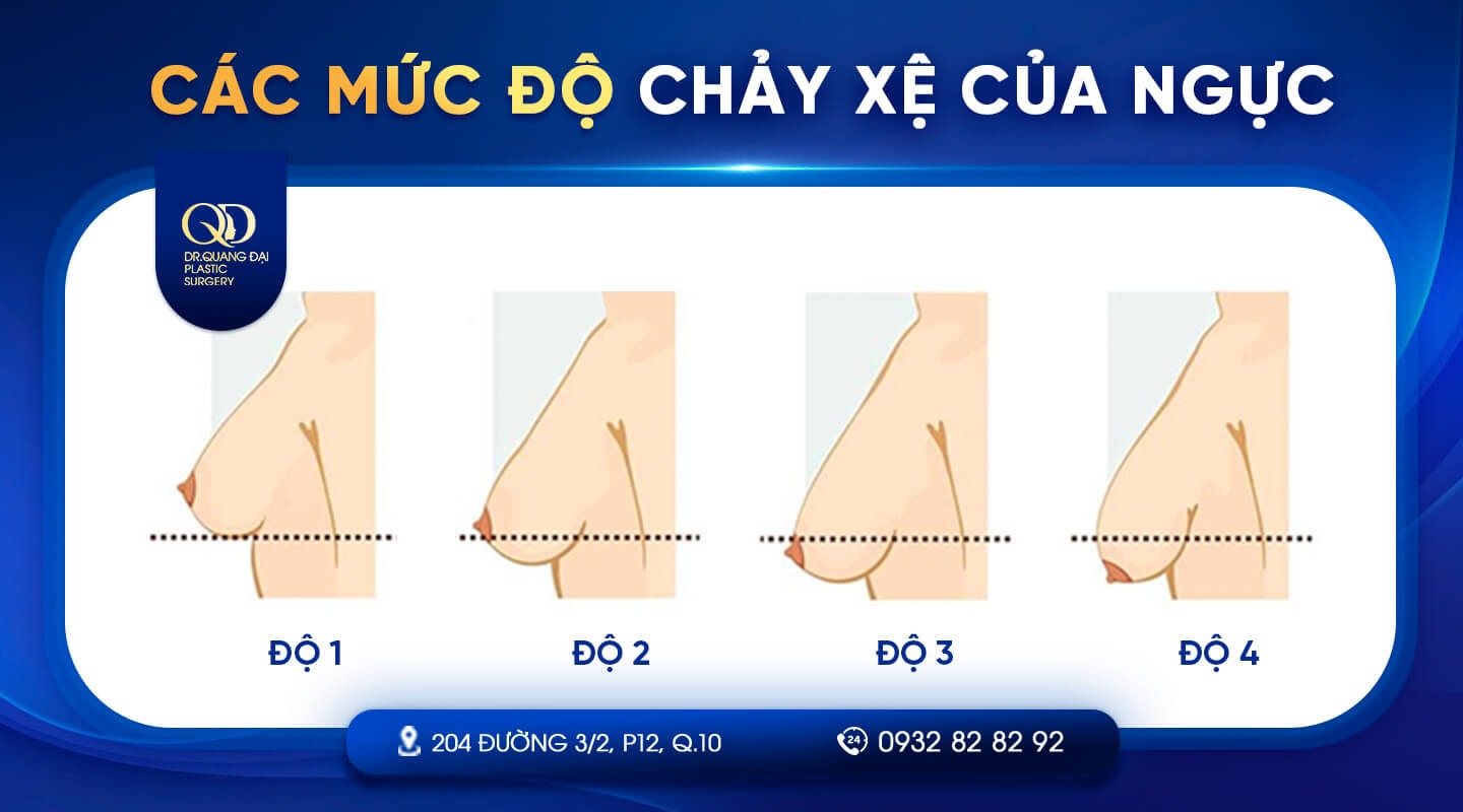 Các Mức Độ Ngực Bị Chảy Xệ