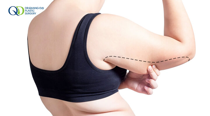 Hút mỡ bắp tay bao lâu thì lành