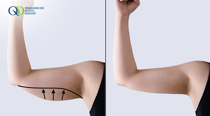 Hút mỡ bắp tay bao lâu thì lành