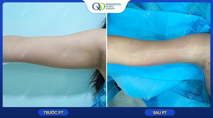 Sau hút mỡ bắp tay có đau không theo từng giai đoạn