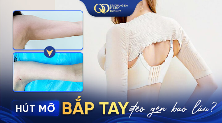 Hút mỡ bắp tay đeo gen bao lâu