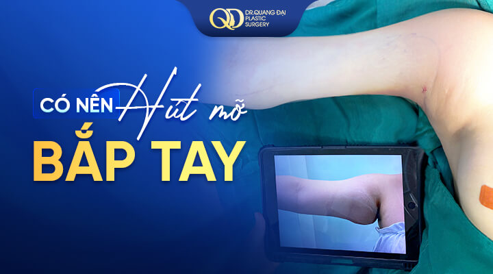 Có Nên Hút mỡ Bắp tay