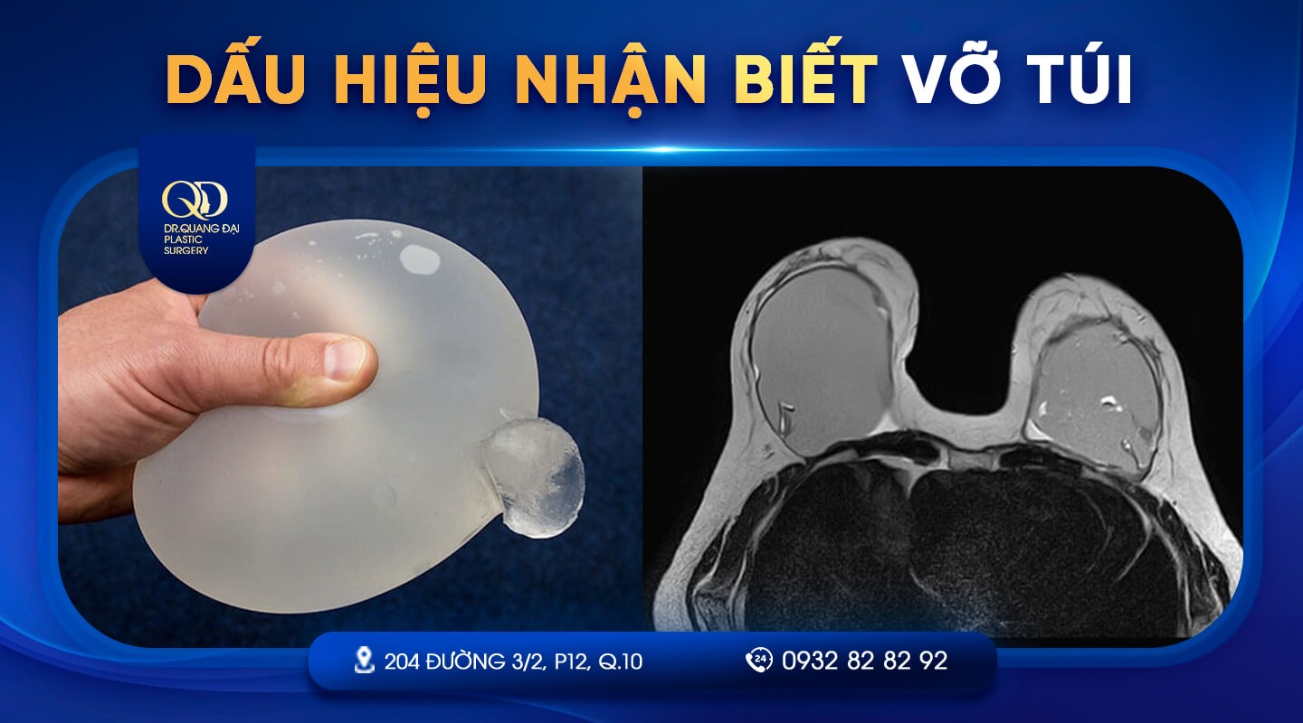 Vỡ túi ngực