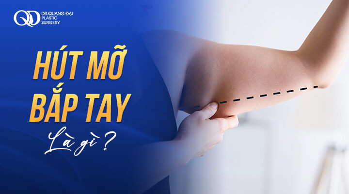Hút mỡ bắp tay là gì