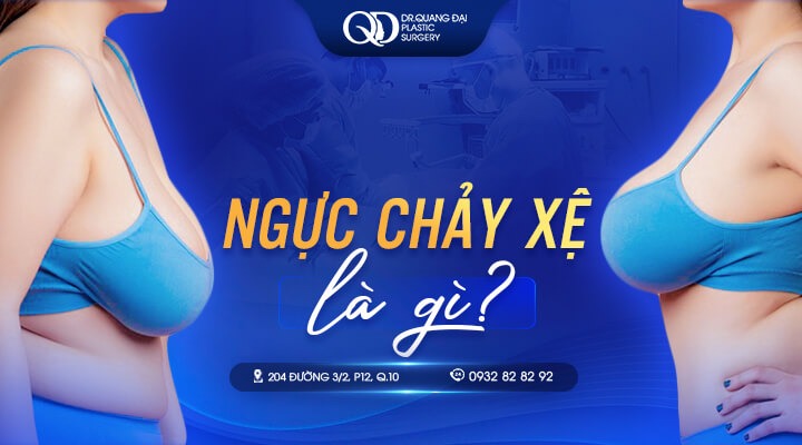 Ngực Bị Chảy Xệ Là Gì