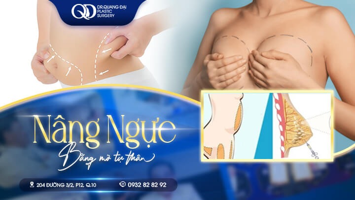 Nâng ngực tự thân là gì