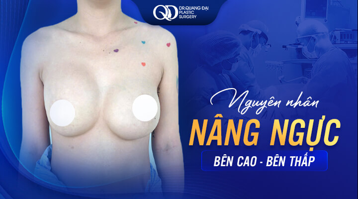 Nguyên-nhân-nâng-ngực-bên-cao-bên-thấp