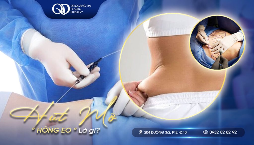Hút mỡ hông eo là gì