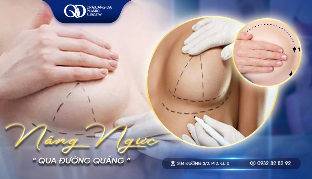 NÂNG NGỰC QUA ĐƯỜNG QUẦNG