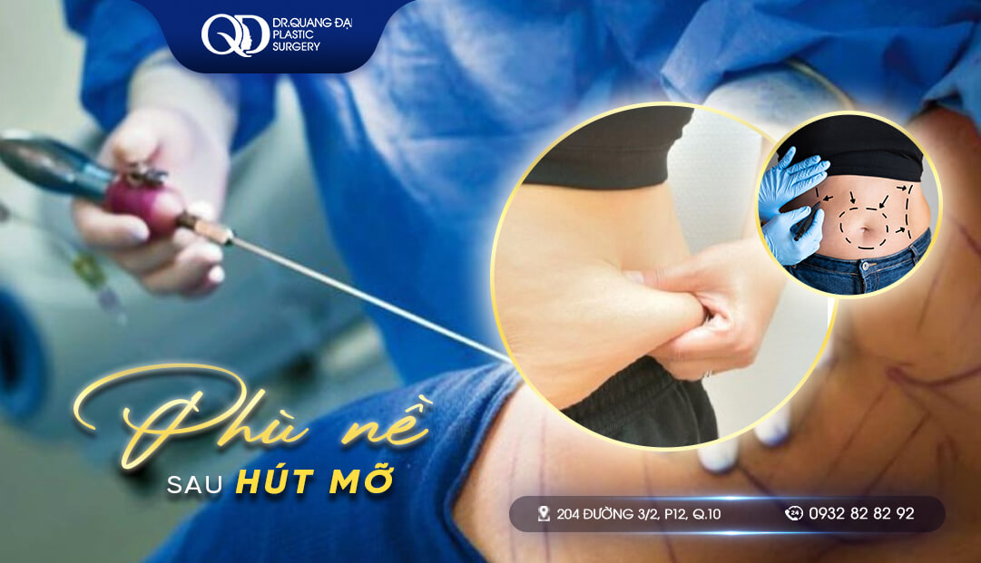 PHÙ NỀ SAU HÚT MỠ_ BIỂU HIỆN, NGUYÊN NHÂN VÀ CÁCH KHẮC PHỤC PHÙ NÈ SAU HÚT MỠ_