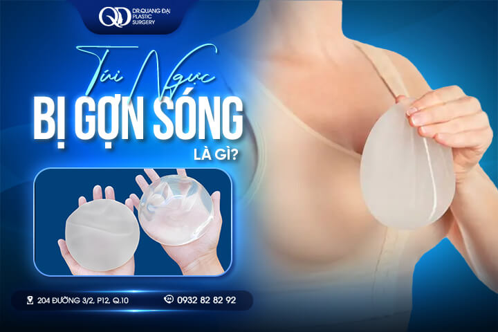 Túi ngực bị gợn sóng-1