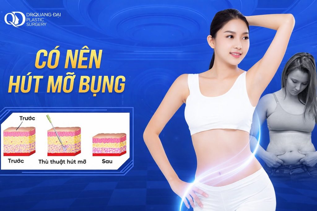 Có Nên Hút Mỡ Bụng