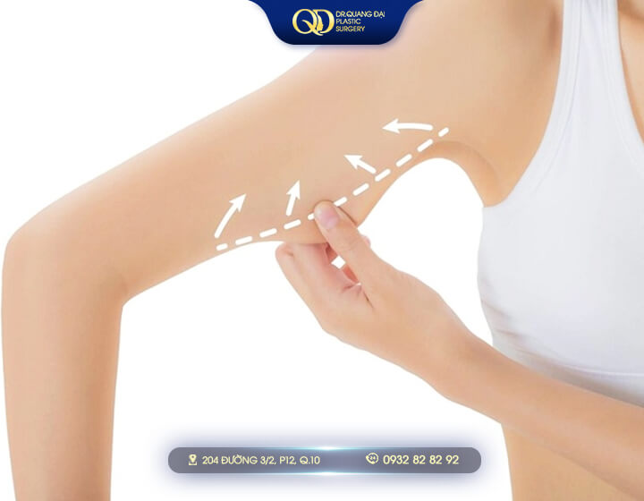 Hút mỡ bắp tay có đau không