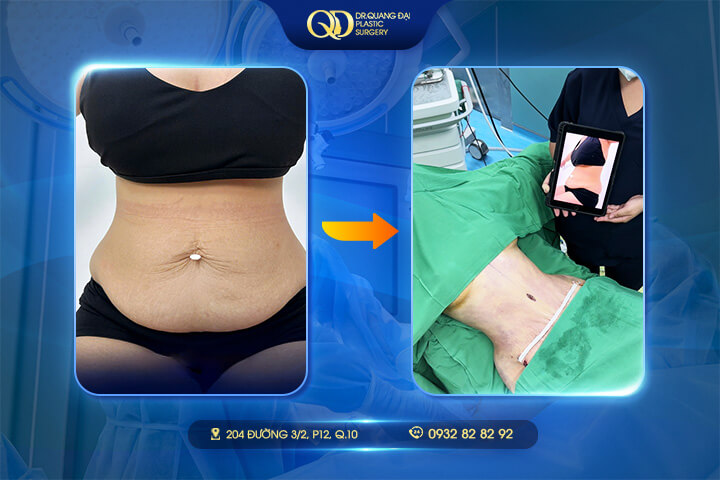 Hút mỡ bụng có đau không