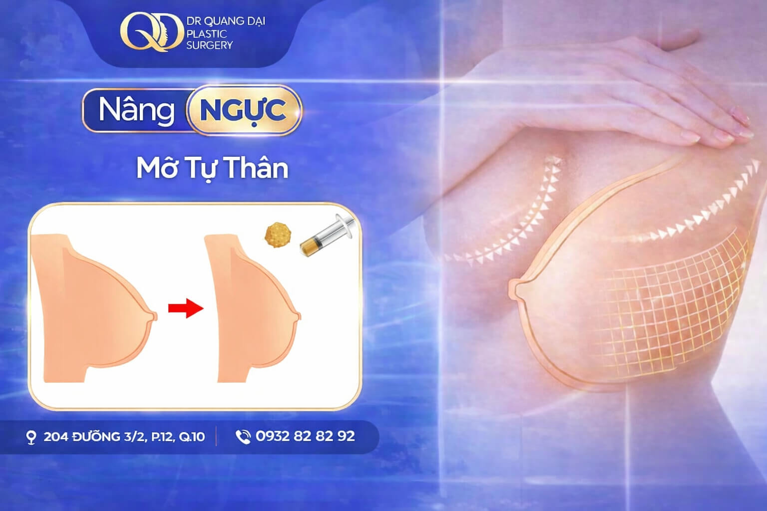 Nâng Ngực Cấy Mỡ Tự Thân