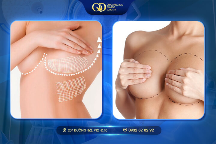 So sánh nâng ngực cấy mỡ tự thân và nâng ngực đặt túi