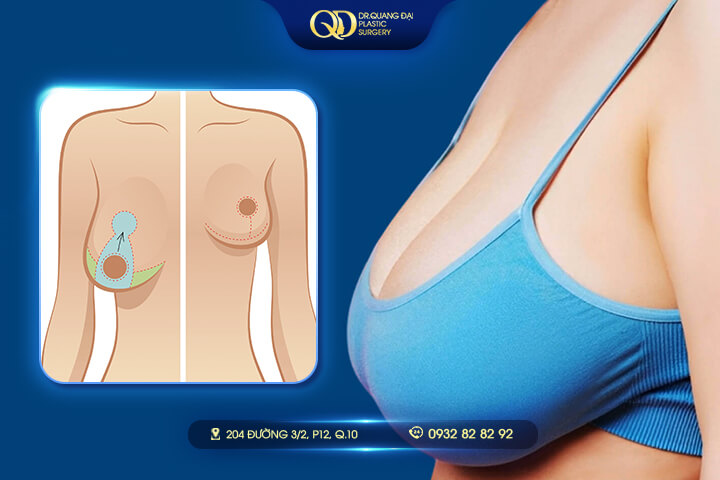 Treo Sa Trễ Ngực