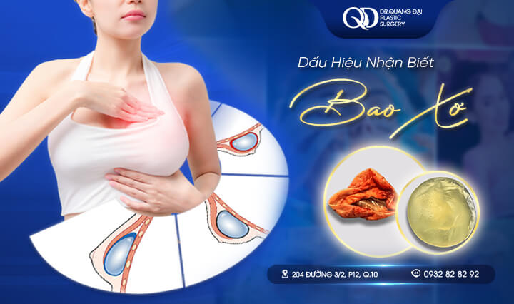 Bao xơ túi ngực là gì – mô xơ hình thành quanh túi ngực sau nâng ngực