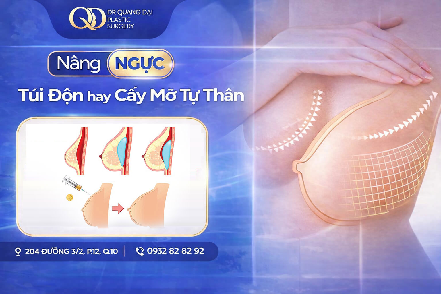 So sánh nâng ngực đặt túi và cấy mỡ tự thân