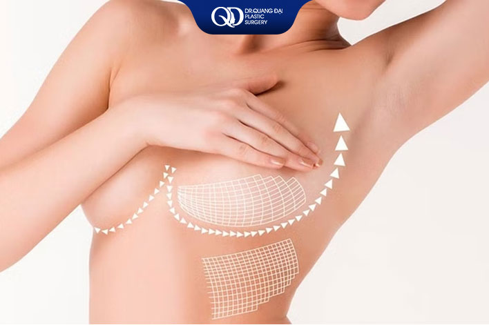 Kỹ thuật treo sa trễ ngực phì đại cần xử lý mô tuyến dư, da chùng và nâng lại vị trí quầng núm vú