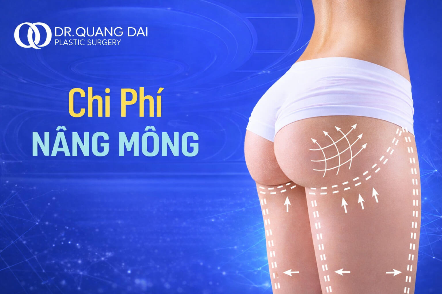 Chi phí nâng mông