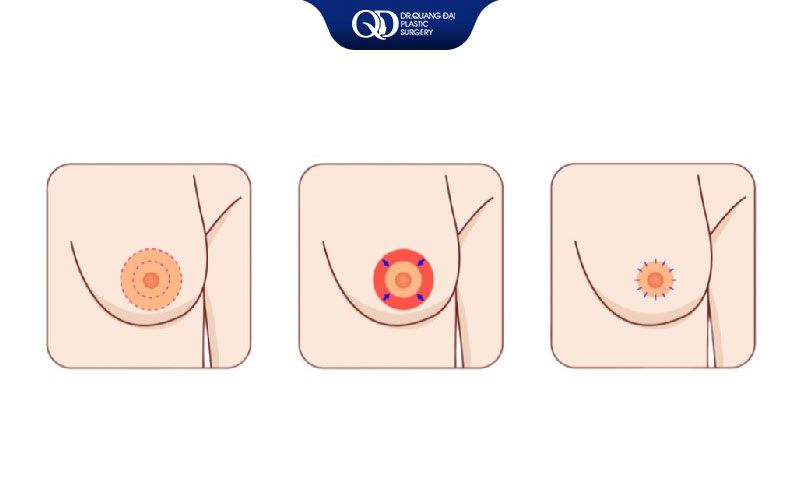 kết quả thu gọn quầng vú đẹp tự nhiên không sẹo