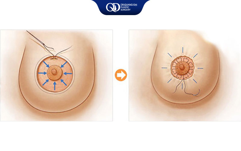thu gọn quầng vú trước và sau cân đối tự nhiên